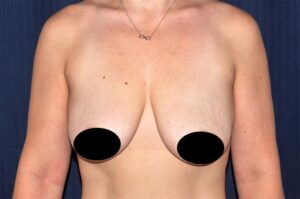Breast Augmentation by Dr. Michael Frederick — before