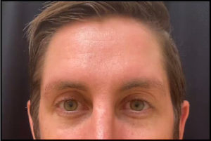Botox by Dr. Michael Frederick — before