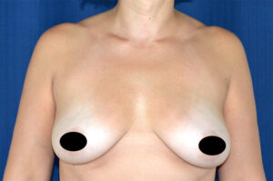 Breast Augmentation by Dr. Michael Frederick — before