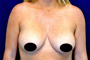 Breast Augmentation by Dr. Michael Frederick — before