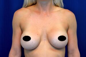 Breast Augmentation by Dr. Michael Frederick — before