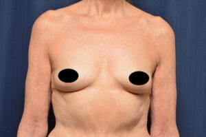 Breast Augmentation by Dr. Michael Frederick — before