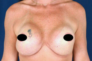 Breast Augmentation by Dr. Michael Frederick — before