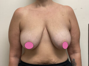 Breast Augmentation by Dr. Michael Frederick — before