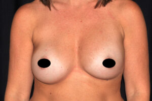 Breast Augmentation by Dr. Michael Frederick — before