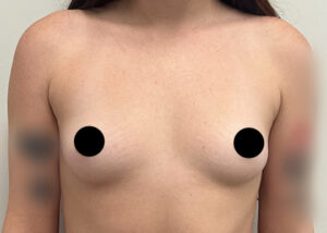 Breast Augmentation by Dr. Michael Frederick — before