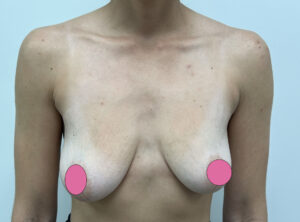 Breast Augmentation by Dr. Michael Frederick — before
