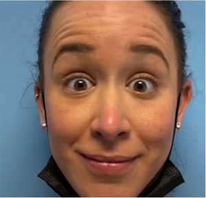 Botox by Dr. Michael Frederick — before