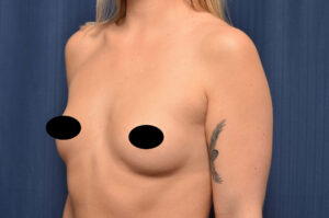 Breast Augmentation by Dr. Michael Frederick — before