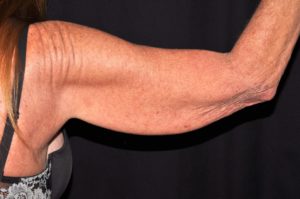 Arm Lift by Dr. Michael Frederick — before