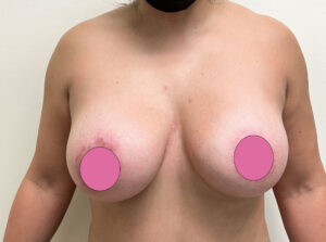 Breast Augmentation by Dr. Michael Frederick — before