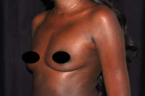 Breast Augmentation by Dr. Michael Frederick — before