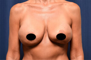 Breast Augmentation by Dr. Michael Frederick — before
