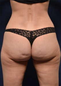 BBL by Dr. Michael Frederick — before