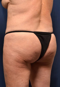 BBL by Dr. Michael Frederick — before