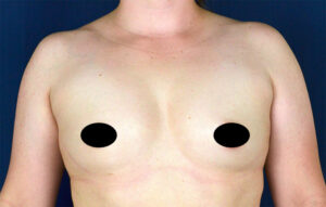 Breast Augmentation by Dr. Michael Frederick — before