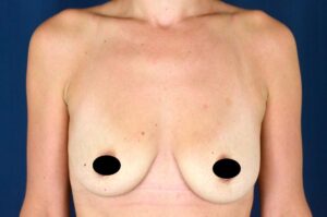 Breast Augmentation by Dr. Michael Frederick — before