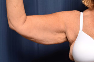 Arm Lift by Dr. Michael Frederick — before