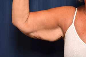 Arm Lift by Dr. Michael Frederick — before