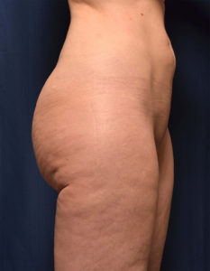 BBL by Dr. Michael Frederick — before