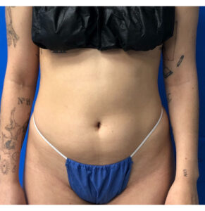 BBL by Dr. Michael Frederick — before