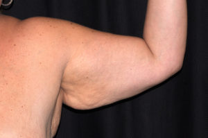 Arm Lift by Dr. Michael Frederick — before