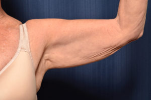 Arm Lift by Dr. Michael Frederick — before