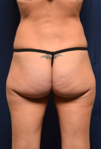 BBL by Dr. Michael Frederick — before