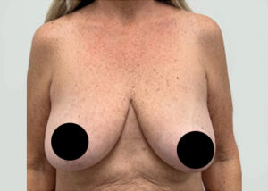 Breast Augmentation by Dr. Michael Frederick — before