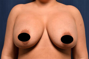 Breast Augmentation by Dr. Michael Frederick — before
