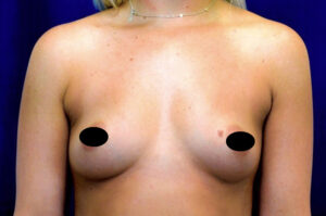 Breast Augmentation by Dr. Michael Frederick — before