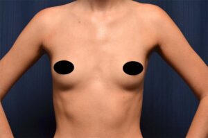 Breast Augmentation by Dr. Michael Frederick — before