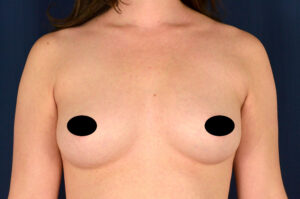 Breast Augmentation by Dr. Michael Frederick — before