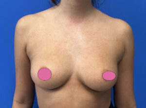 Breast Augmentation by Dr. Michael Frederick — before