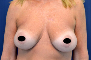 Breast Augmentation by Dr. Michael Frederick — before