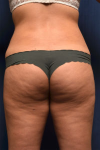 BBL by Dr. Michael Frederick — before