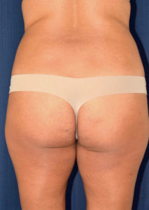 BBL by Dr. Michael Frederick — before