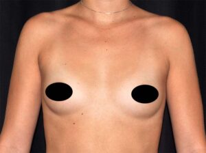 Breast Augmentation by Dr. Michael Frederick — before