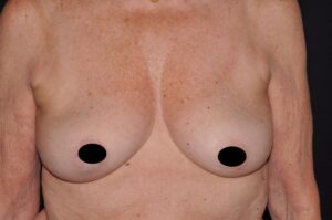 Breast Augmentation by Dr. Michael Frederick — before