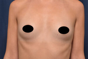 Breast Augmentation by Dr. Michael Frederick — before