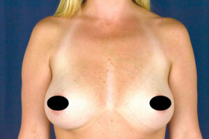 Breast Augmentation by Dr. Michael Frederick — before