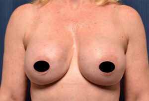 Breast Augmentation by Dr. Michael Frederick — before