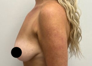 Breast Augmentation by Dr. Michael Frederick — before