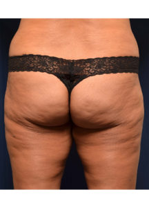 BBL by Dr. Michael Frederick — before