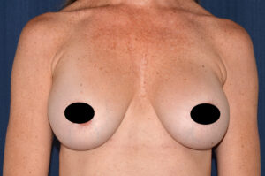 Breast Augmentation by Dr. Michael Frederick — before