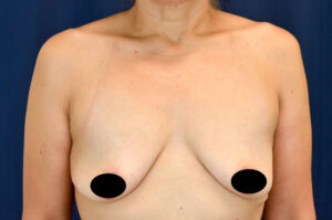 Breast Augmentation by Dr. Michael Frederick — before
