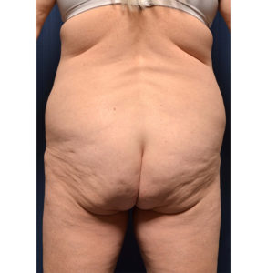 BBL by Dr. Michael Frederick — before