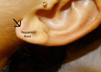 Earlobe Repair before and after - after