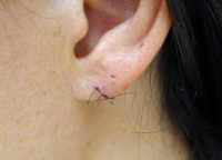 Earlobe Repair before and after - before