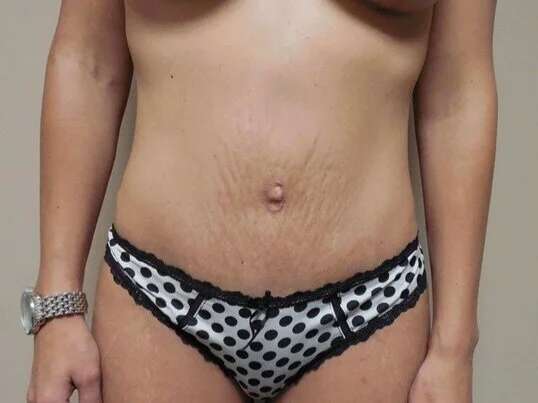 Tummy Tuck before and after - after